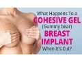 What Happens To a Cohesive Gel Gummy bear Breast Implant When It s Cut
