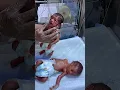 Download Lagu Perform physiothropy to cute 🥰 baby baby felling very well #miraclebaby #miraclebabies #adorablebab