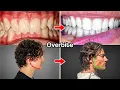 I Spent 9 Months Fixing My Overbite Naturally 4-Step Guide