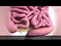 3D Animated Surgical Procedural - Sigmoid Colon Resection Sample SurgTalk