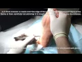 Download Lagu One-stitch Instep  Fasciotomy For Chronic  Plantar Fasciitis/heel Spur Syndrome