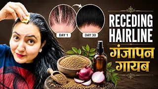30 Days *Hairline Regrowth* Challenge : Receding Hairline, Bald Patches हल्के बालों को करें घना