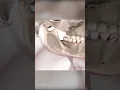 Corrective Jaw Surgery Orthognathic Surgery