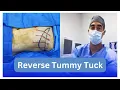 Reverse Tummy Tuck with Dr Zuri in Miami Zuri Plastic Surgery