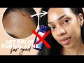 HOW TO TREAT FUNGAL ACNE Malassezia FAST THE BEST WAY