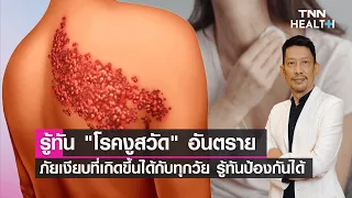  วัคซีนงูสวัสดิ์มีประโยชน์อย่างไร และควรฉีดเมื่อไหร่สำหรับคนทั่วไป 