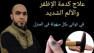 علاج كدمة الإظفر والتجمع الدموي والألم الشديد في ثواني بدون طبيب العيادة موريا مول موريا مول دندنها