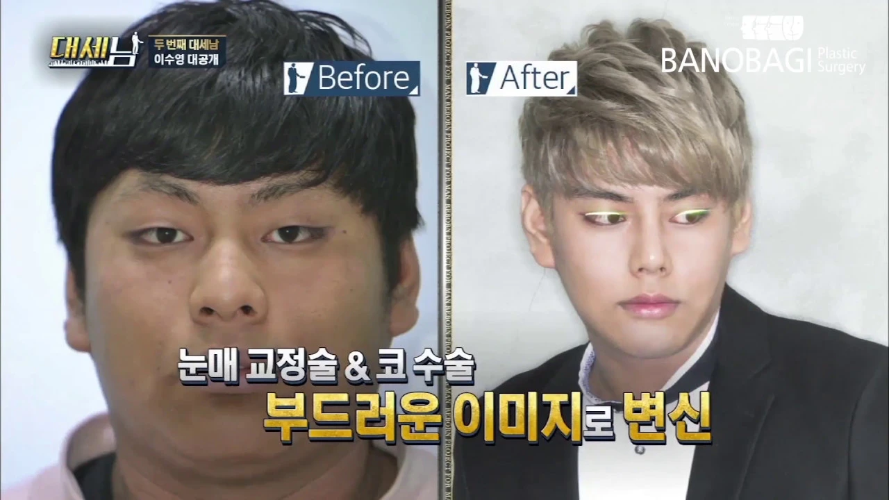 [바노바기] "나는 바노바기에서 멋있어졌다."_ 윤곽수술/지방흡입수술 후기 '남자성형'
