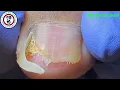 Download Lagu Extreme Ingrown Toenail Cleaning! 😳 ASMR