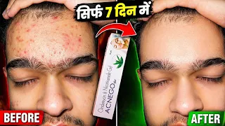 7 Days Acne Gone? Acnego Gel Honest Review!