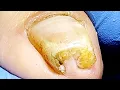 Noticeably Curled Toenails, Removal Of Ingrown Toenails【Pedicure King】