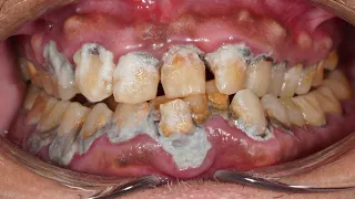 42-Year-Old Patient Dental Cleaning | Heavy Calculus Removal