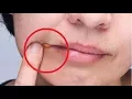 Home Remedies for Angular Cheilitis