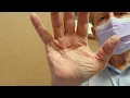 Mayo Clinic Minute - Treating Dupuytren s contracture without surgery