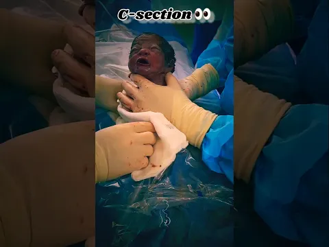 🥹 A TINY MIRACLE! BABY’S FIRST MOMENTS AFTER C-SECTION 👶❤️ #CSection #Baby #mom #family #new #best