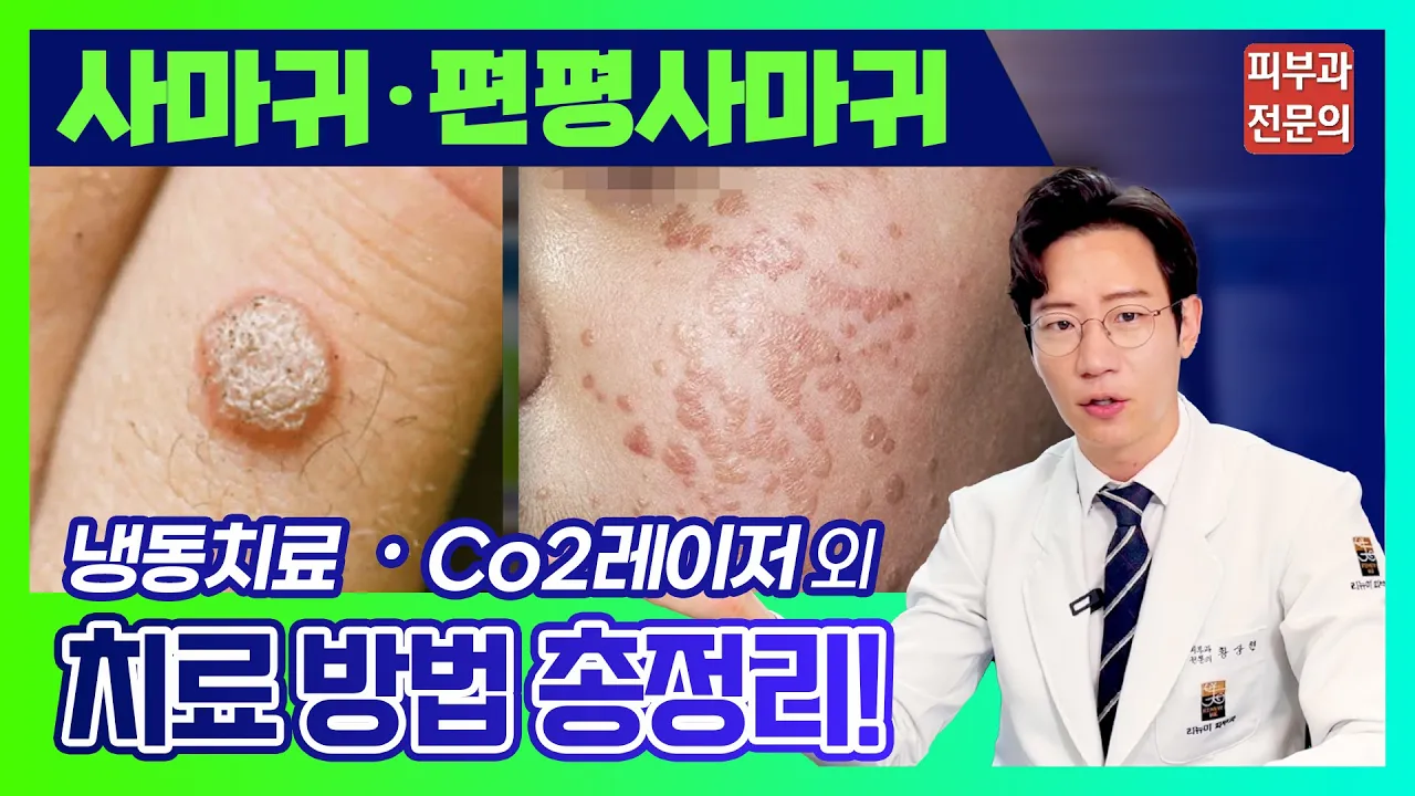 편평사마귀 제거⭐️ 이렇게 합니다 [치료법∙전염성∙원인∙비슷한 질환∙레이저 등] 재발은 그만✋