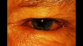Correction of Trichiasis CPT code - simplify medical coding