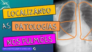 Pulmões no RX - Parte 2/2 - Como localizar as patologias no RX