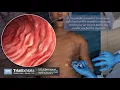 Download Lagu Percutaneous Endoscopic Gastrostomy (PEG Tube) Insertion