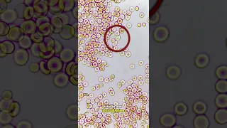 White Blood Cells Fight Infection Under The Microscope RARE FOOTAGE 