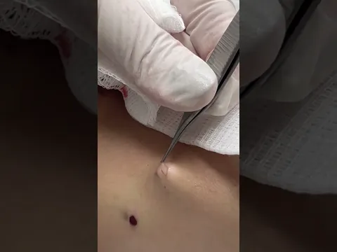 The Squeeze Is Only Half The Job | Dr. Pimple Popper vs. Steatocystomas