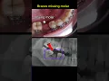 Braces for missing molar Braces journey