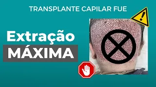 Extração Máxima no transplante capilar FUE