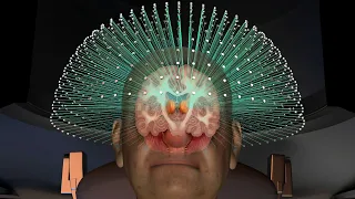 Focused Ultrasound Treatment for Essential Tremor UCSF Neurosurgery