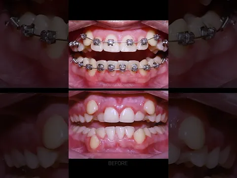 Download MP3 Braces process