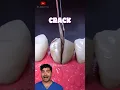 Download Lagu Cracked Tooth !?