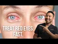 How to get rid of red eyes FAST Ophthalmologist MichaelRChuaMD