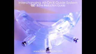 Interchanging All On X Full Arch Guide System Higher Stability Stackable Guide Alternative 