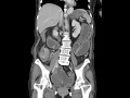 Extraperitoneal bladder perforation Ahuja AT et al 2017 Book Essential Radiology