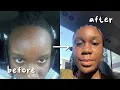 How I Cleared my Fungal Acne in one month detailed