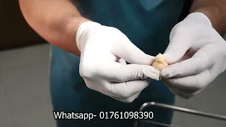 Epidermal inclusion cyst surgery