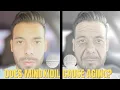 Does Oral Minoxidil Cause Aging Decrease Collagen Reduction Dr Oscar Munoz Responds