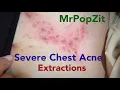 Large clogged pores emptied from chest area Extraction techniques Many curled ingrown hairs removed