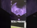 Prostatic Abscess TRUS Guided Drainage Pus Inside the Prostate