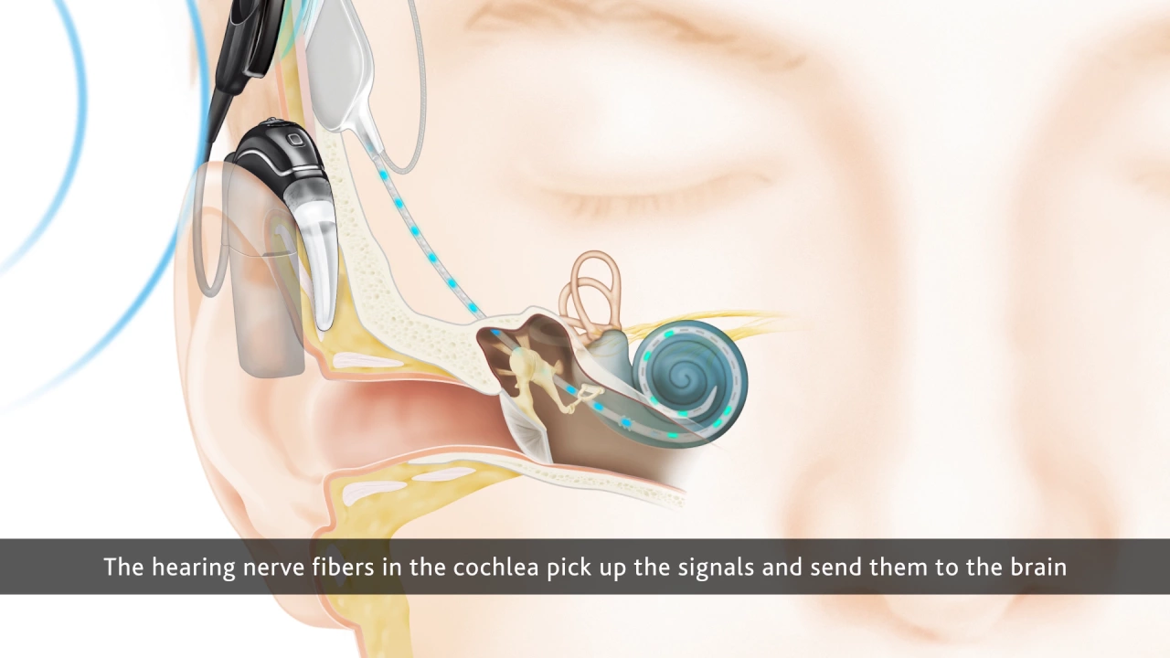 How Cochlear Implants Work