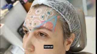 Toxina botulínica AO VIVO com todos os detalhes desde o início até a avaliação dos retoques finais