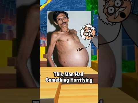 His Twin Was Living Inside Him 😨