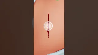 عملية جراحية استئصال الزائد الدودية Appendectomy Surgery Surgery عمليات جراحية طب طبيب 