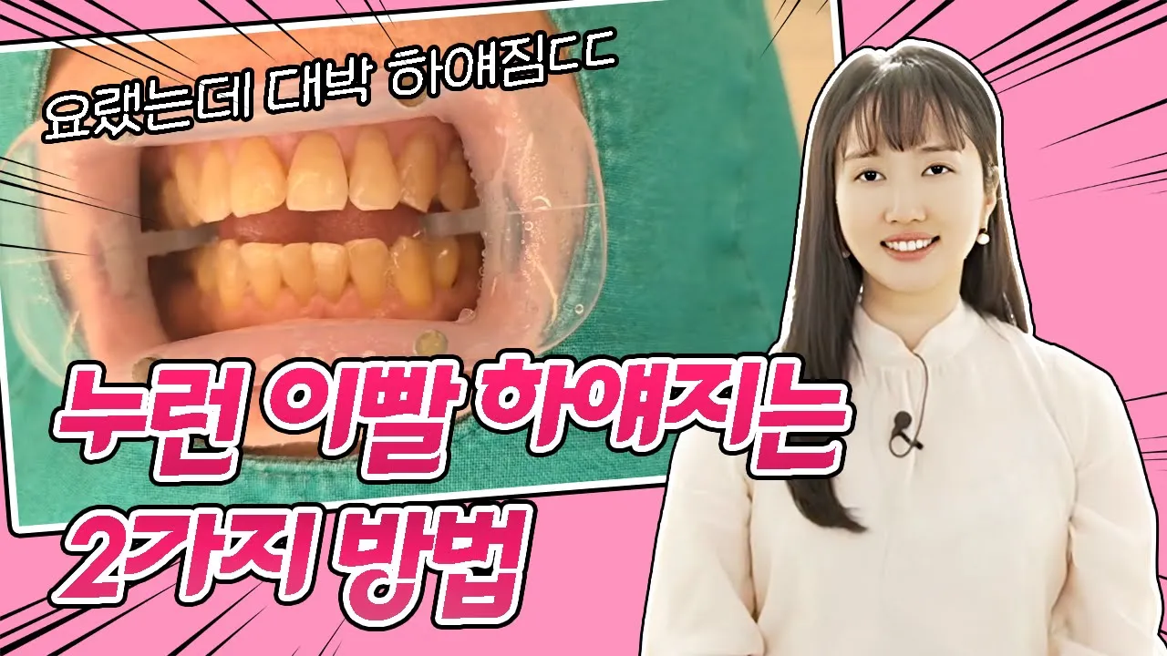 누런 이, 누런 치아, 누렁니, 노란 이빨, 황니, 누래진 이빨💦 하얀 치아 만드는 방법! 🦷 I 스마일뷰치과 러블리 김원장