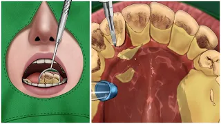 [ASMR] 10년넘게 쌓인 거대 치석제거 / Removal of massive tartar that has built up over 10 years