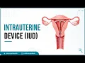 Intrauterine Device IUD Copper T Removal procedure Patient Education Medical animation USMLE