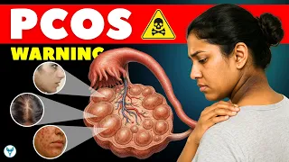 PCOS Early Signs You Can’t Afford to Ignore | Irregular Periods & Acne Explained
