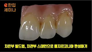 full zirconia theory completing the look with gingival build up and crown stain noritake czr