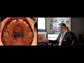 MSE expander explained by Dr Derek Mahony Dr Isabel Drewling on an interview with Karina