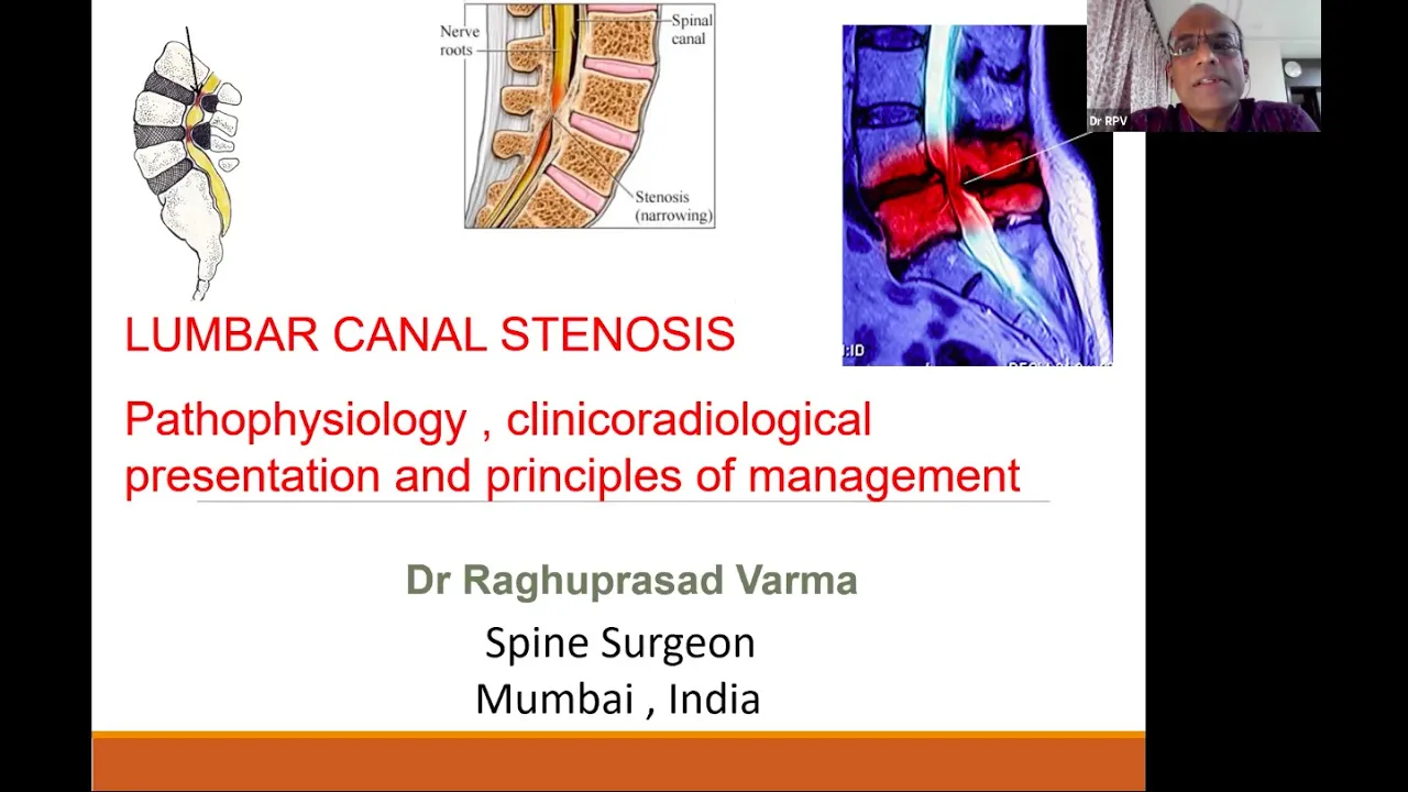 Spinal Stenosis: Diagnosis and  Treatment with Dr. Kurd. 