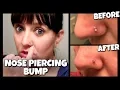 How To Get Rid Of A Nose Piercing Bump FAST Keloid How To With Kristin